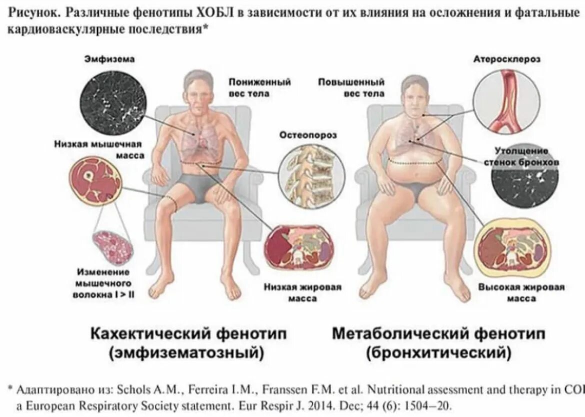Признаки хобл легких. Основные клинические симптомы хобл. лгхроническая обструктивная болезнь лёгких. хроническая обструктивная болезнь легких симптомы.