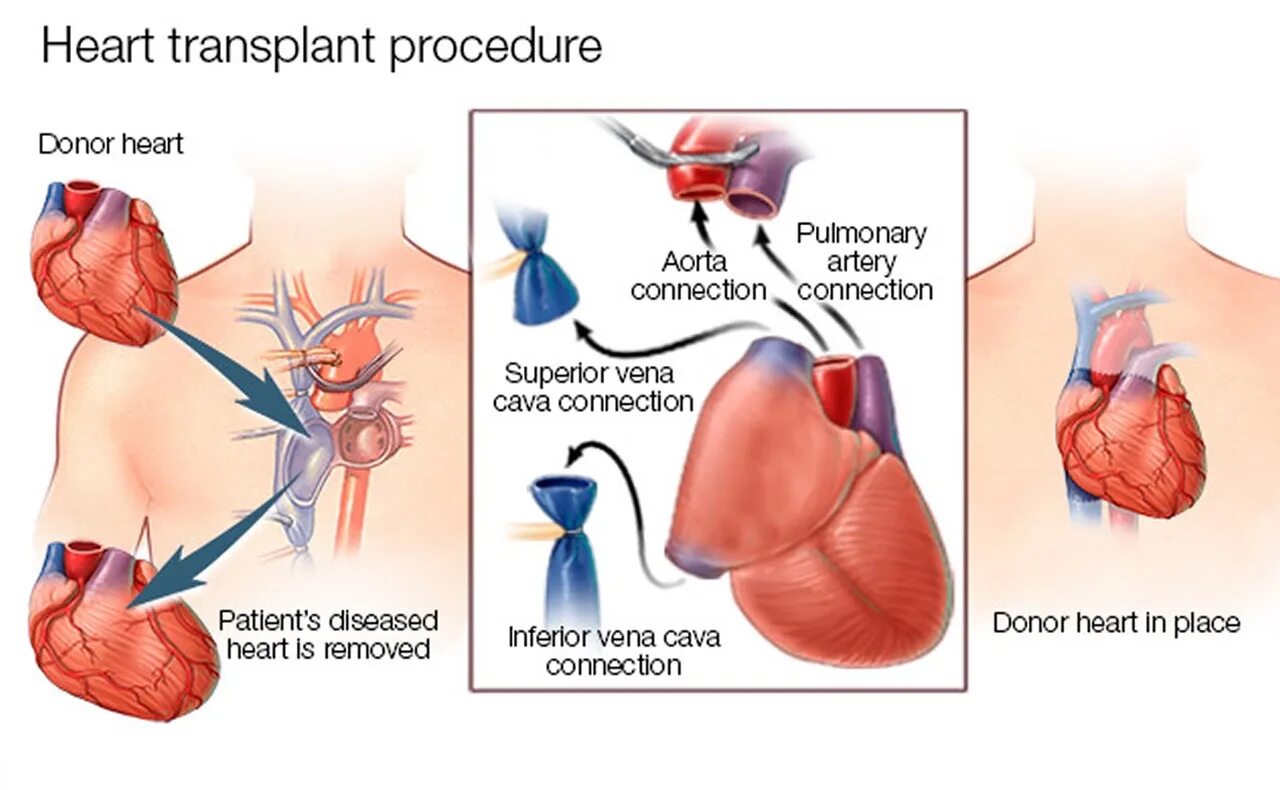 Сколько живут после пересадки. Трансплантация сердца. Трансплантация сердца техника. Трансплантология сердца. Трансплантация сердца схема.