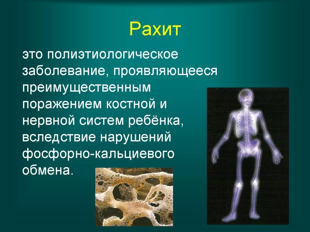 Рахит наследственное заболевание. Рахит генетическое заболевание. Рахит вызывает недостаток витамина