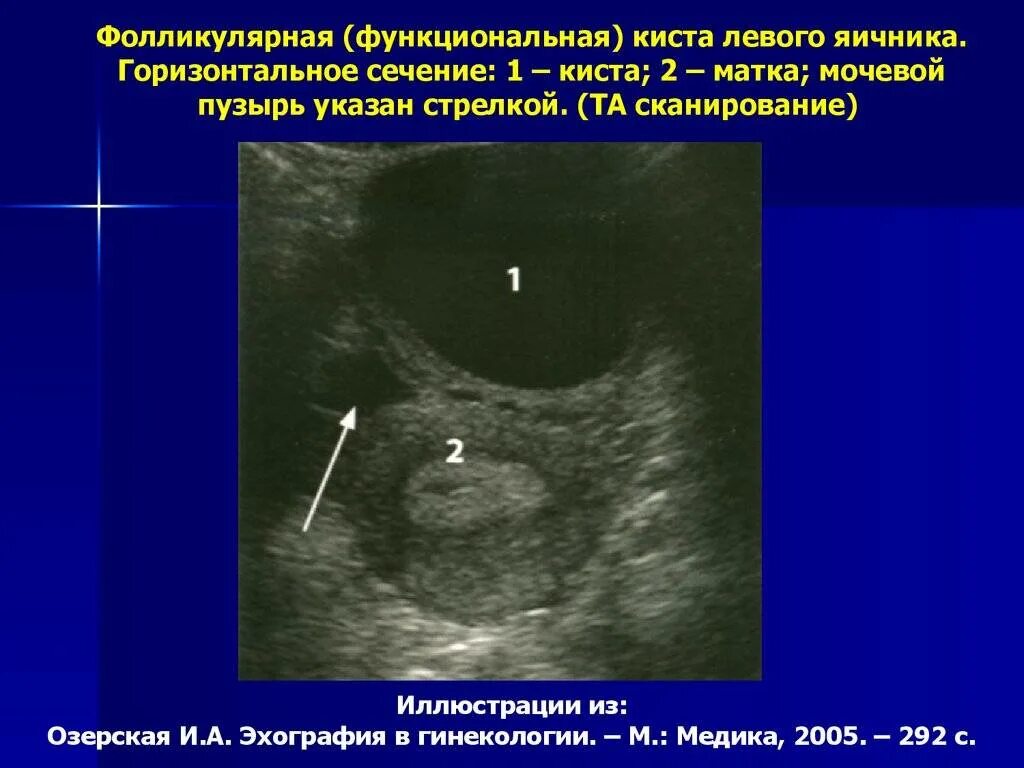 Функциональные ретенционные кисты яичников. Ретенционное образование яичника УЗИ. Киста яичника на УЗИ 5см правого. Структура фолликулярной кисты.