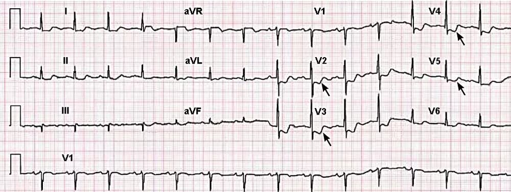 Депрессия сегмента st. Инфаркт миокарда с подъемом сегмента St. Депрессия сегмента St на ЭКГ ишемия миокарда. Инфаркт миокарда без подъема сегмента St ЭКГ. Инфаркт на ЭКГ С депрессией сегмента St.