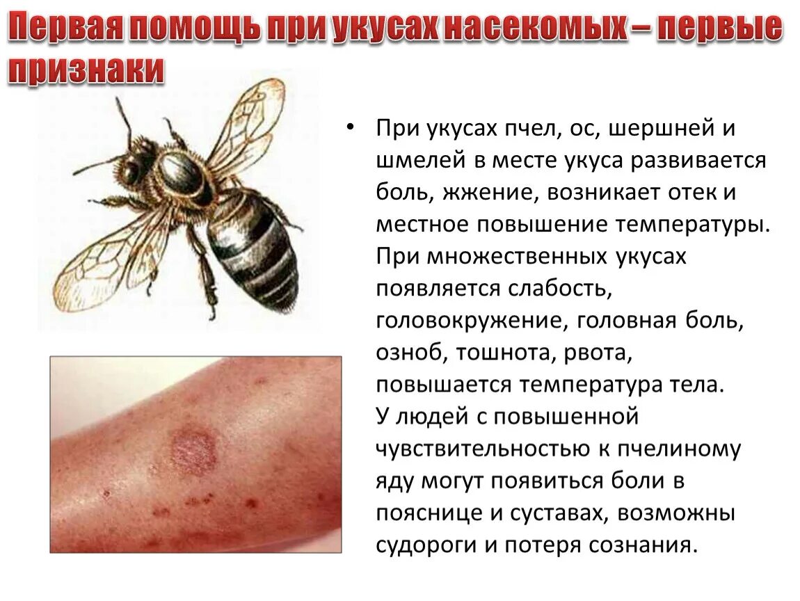 Помощь при укусе осы. Симптомы при укусе пчелы.