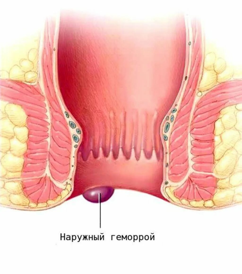 Ощущение в прямой кишке. Подкожный парапроктит. Узел геморроидальный узел. Геморроидальный узел анальный.