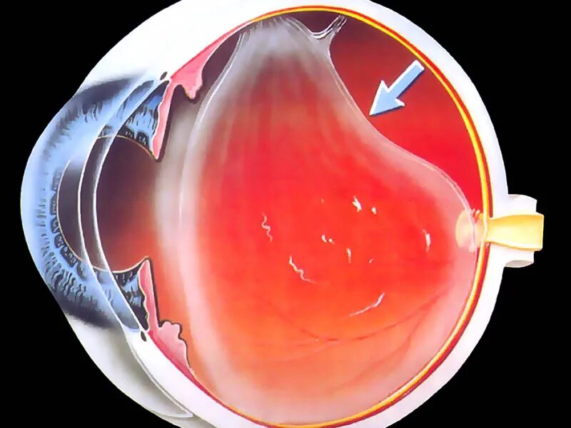 Регматогенная отслойка сетчатки. Транссудативная отслойка сетчатки. Задняя гиалоидная мембрана стекловидного тела. Отслойка стекловидного тела. Прозрачное тело в глазу