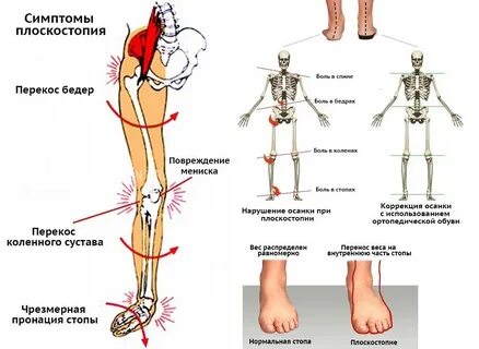 Плоскостопие сильно болят ноги