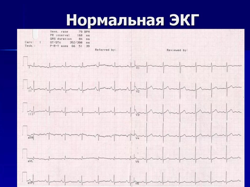 ЭКГ норма в 12 отведениях. ЭКГ сердца норма снимок. Норма ЭКГ во всех отведениях. QRST на ЭКГ норма. Платные услуги экг