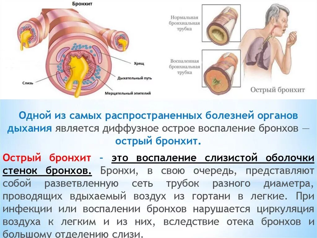 Причины частых бронхитов. Механизм развития бронхита. Этиология бронхита. Острый простой бронхит этиология.