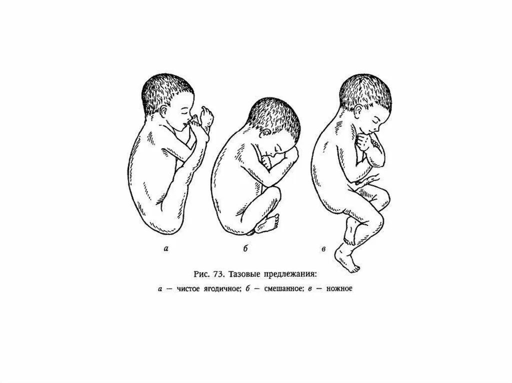 Тазовое предлежание показание. Тазовое предлежание смешанное ягодичное. Тазовое ножное предлежание плода. Ягодично ножное предлежание плода. Тазовое предлежание плода ножное предлежание плода.