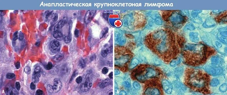 Диффузная лимфома прогноз. Анапластическая крупноклеточная лимфома гистология. анапластическая крупноклеточная лимфома кожи. анапластическая крупноклеточная лимфома цитология.