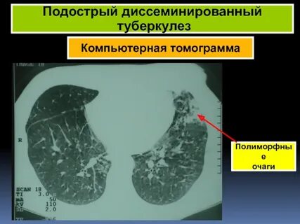Туберкулез на кт