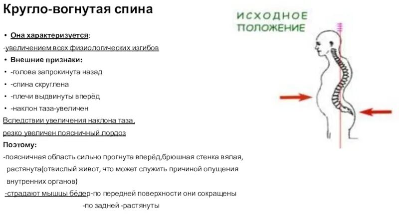 Вогнуто круглая спина. Кифоз позиционный м40. Вогнуто круглая спина. Нарушение осанки круглая спина. Массаж при нарушении осанки.