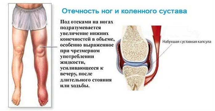 Дискомфорт на внутренней стороне колена. Боль в колене с внутренней стороны. Боль в колене схема. Болит колено опухает чем лечить. Болит колено опухает чем лечить.