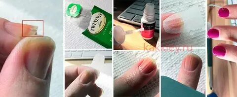 Чем можно заклеить ноготь