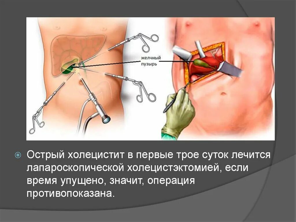 Болит после операции желчный пузырь. ЖКБ лапароскопическая холецистэктомия. Холецистит и лапароскопическая холецистэктомия. Острый холецистит желчного пузыря.