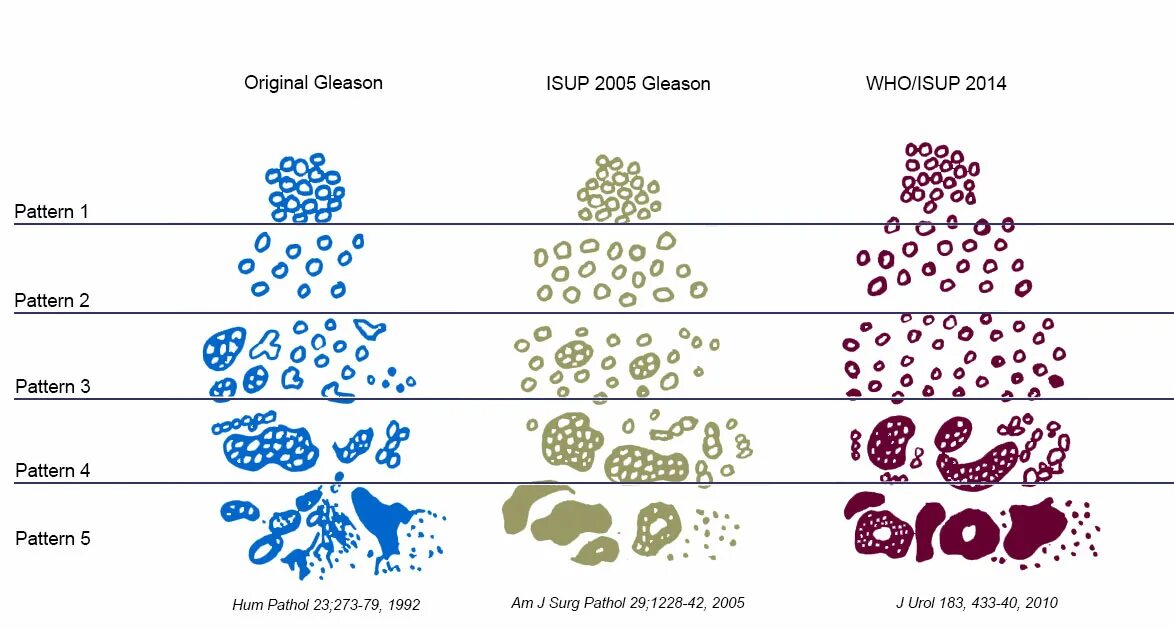 Глисон рак предстательной. Gleason классификация. Gleason score. Глисон шкала. Оценка по Gleason 3+4.