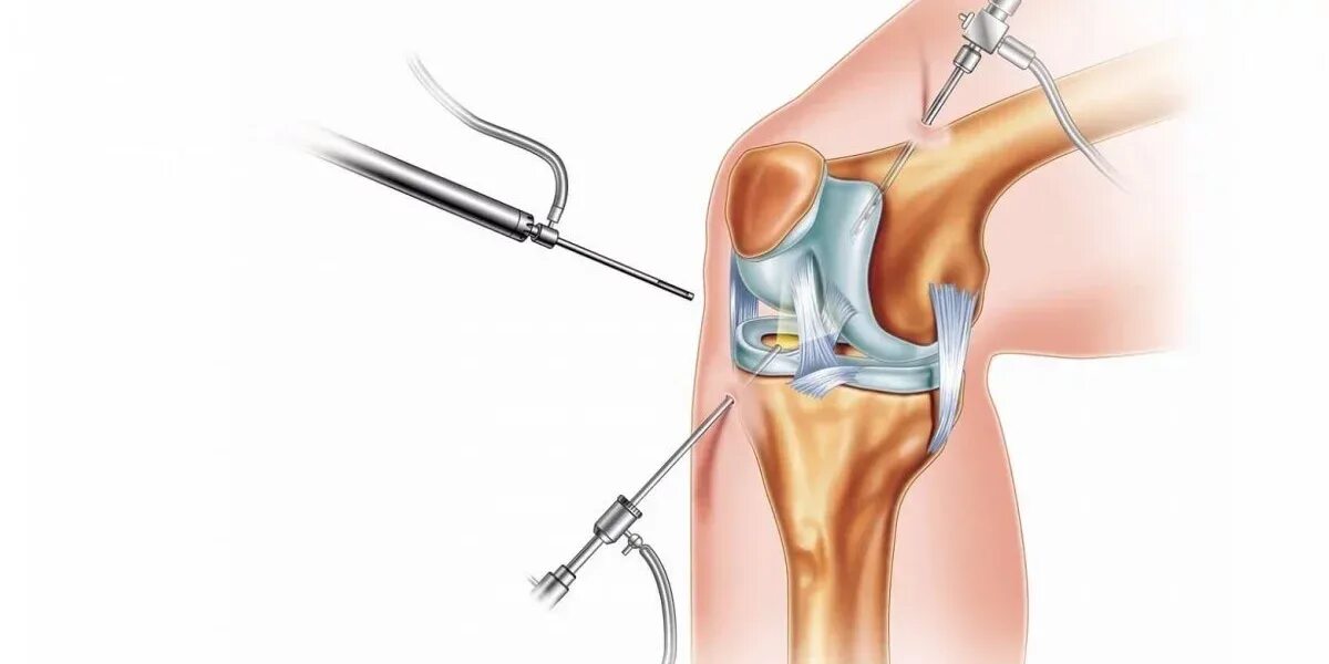 Артроскопическая резекция медиального мениска. Артроскопия коленного сустава шрамы. Ревматоидный артрит артроскопия. Восстановление сустава без операции