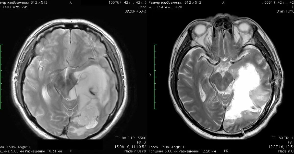 Ганглиоглиома левой височной доли. Объемные образования височной доли. Опухоль височной доли мрт. Глиальная опухоль головного