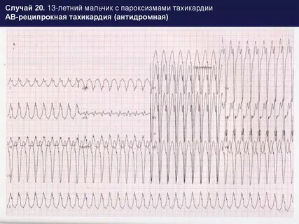 Реципрокная тахикардия