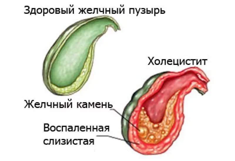 Можно ли вылечить желчный пузырь. Здоровый и воспаленный желчный пузырь. флегмонозный холецистит. желчный пузырь здоровый и с хроническим холециститом. острое воспаление желчного пузыря.