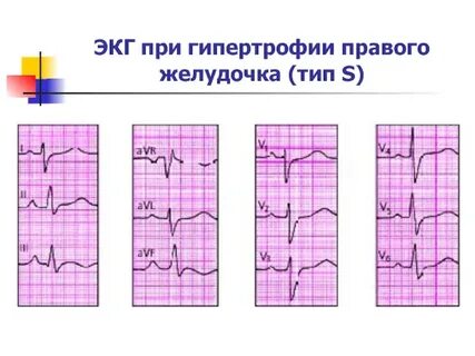 Гипертрофия правого