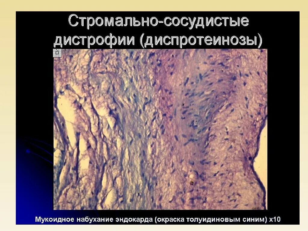 Мезенхимальные белковые. Мезенхимальные жировые дистрофии патанатомия. Макропрепарат мезенхимальные жировые дистрофии. Ожирение мезенхимальная дистрофия микроскопия. Белковые дистрофии патанатомия.