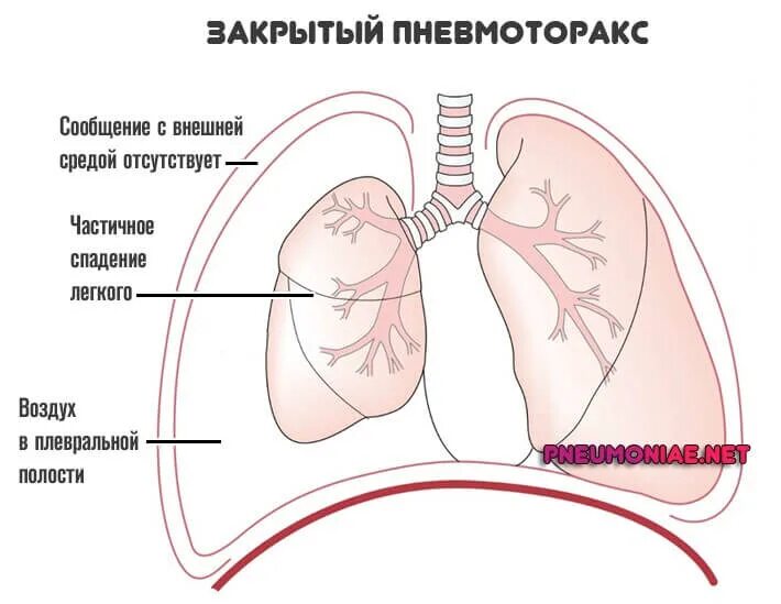 Пневмоторакс открытый закрытый клапанный. Закрытый клапанный пневмоторакс. Пневмоторакс спавшееся легкое. 1. Спонтанный пневмоторакс. Почему уменьшается легкое