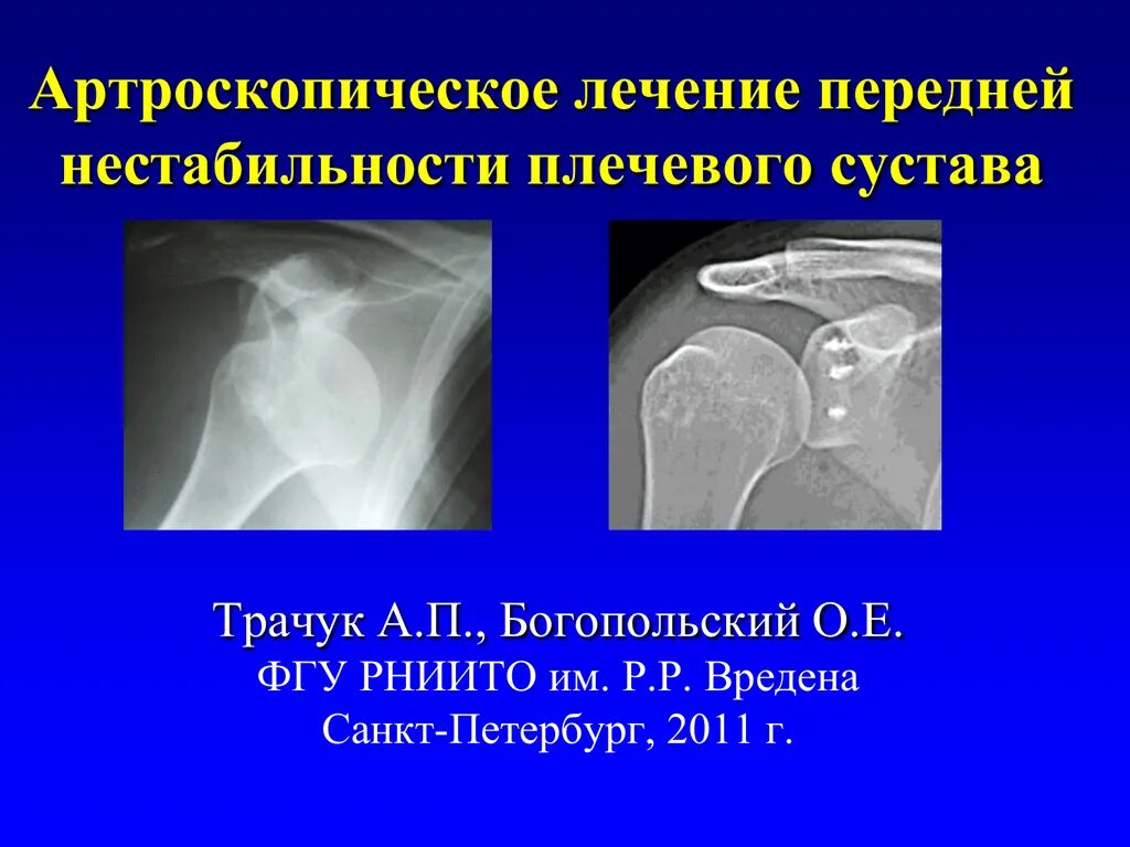 Хроническая нестабильность сустава. Нестабильность голеностопного сустава. Нестабильность коленного сустава. Нестабильность плечевого сустава диагноз. Хроническая нестабильность сустава.