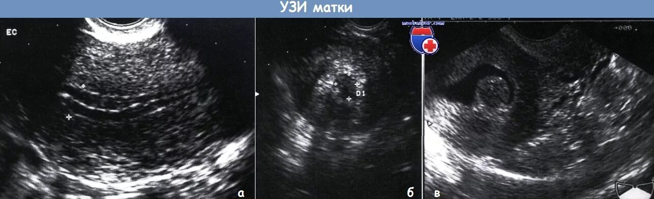 Эндометрия 10мм