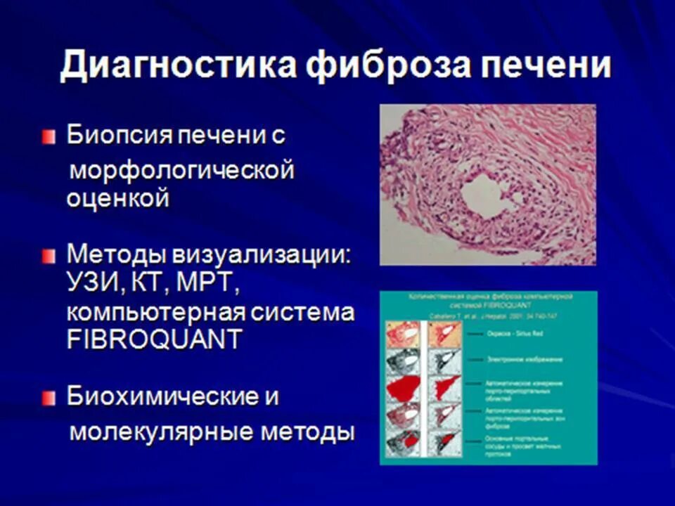 Цирроз печени патанатомия животных. Билиарный цирроз печени гистология. Цирроз печени гистология. Алкогольный фиброз. Постнекротический цирроз печени макропрепарат.