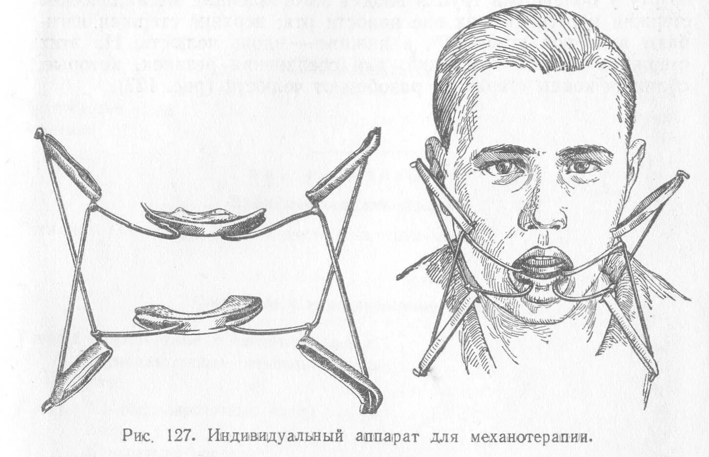 Аппарат Оксмана при переломе нижней челюсти. Контрактуры нижней челюсти аппарат Оксмана. Аппарат Лимберга для механотерапии. Захват челюсти