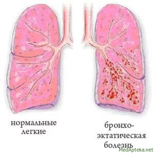 Бронхоэктатическая болезнь клинические рекомендации. Мокрота при бронхоэктатической болезни. Стадии бронхоэктатической болезни. Бронхоэктатическая болезнь (бронхоэктазы). Стадии бронхоэктатической болезни.