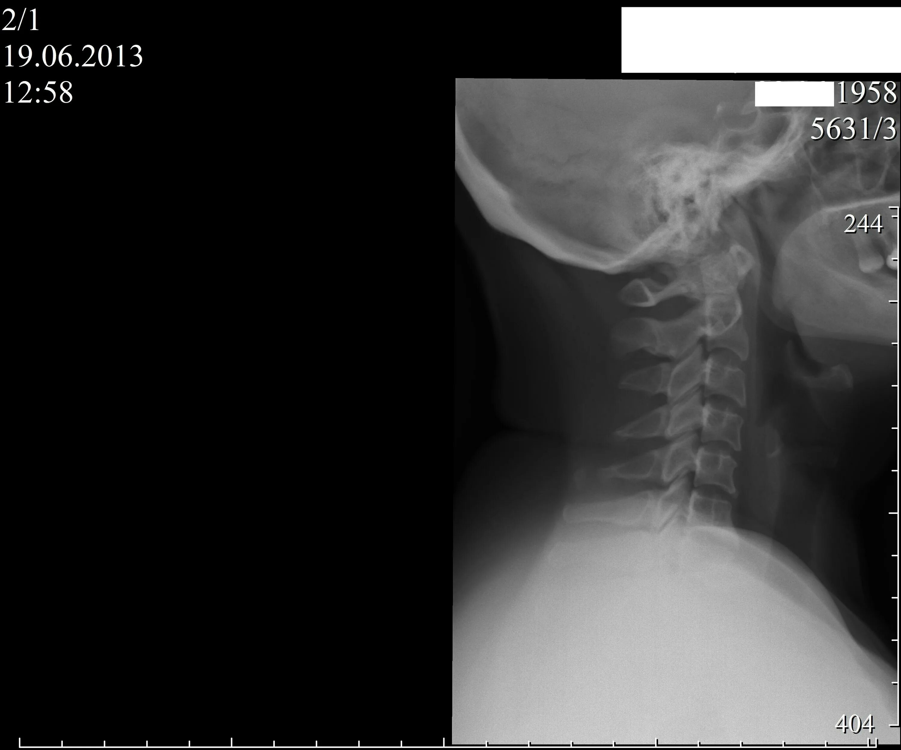 Рентгенография позвоночника в 2 х проекциях. Рентген шейного отдела в 2 проекциях. Блок позвонков шейного отдела. Рентген шейного отдела позвоночника. Рентген шейного отдела позвоночника в 2 проекциях.