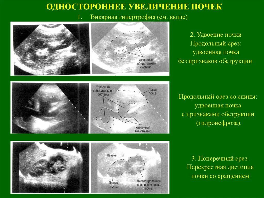 Признаки члс. Удвоение почки УЗИ протокол. Признаки удвоения почки на УЗИ. Удвоение ЧЛС почек на УЗИ признаки. Удвоение ЧЛС левой почки протокол УЗИ.