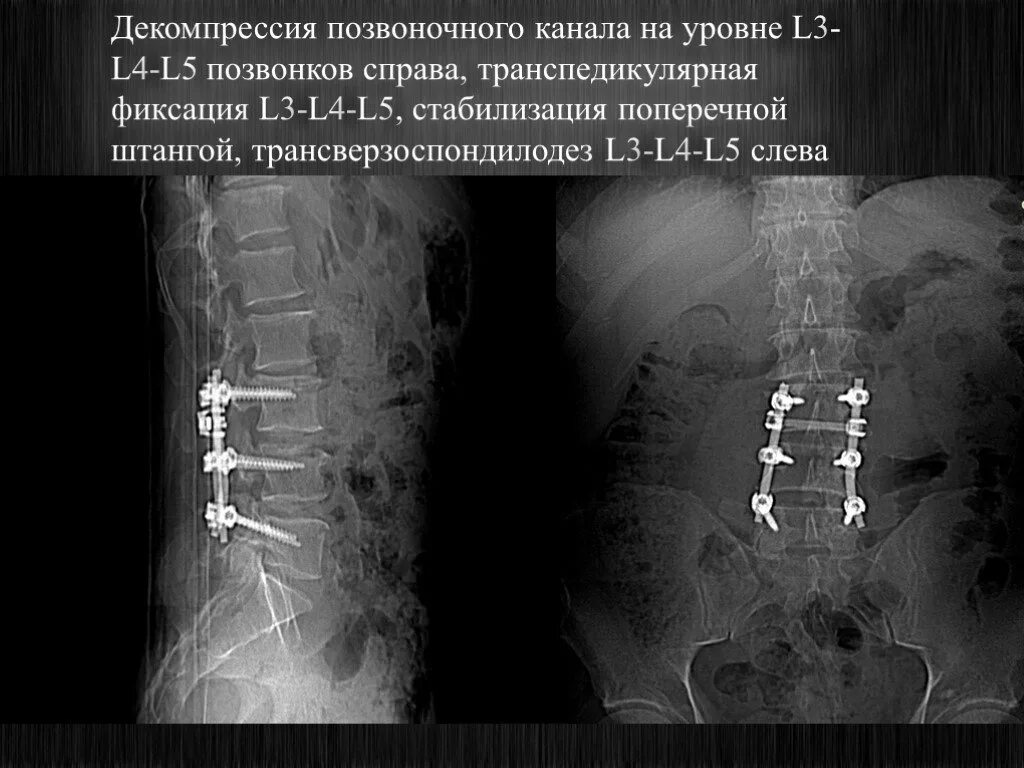 Дегенеративный спинальный стеноз l3-l4. Остеосинтез позвоночника l1 транспедикулярной. Транспедикулярная фиксация позвоночника l5-s1. Стеноз дурального мешка поясничного отдела. Пояснично крестцовый отдел операция на позвоночнике