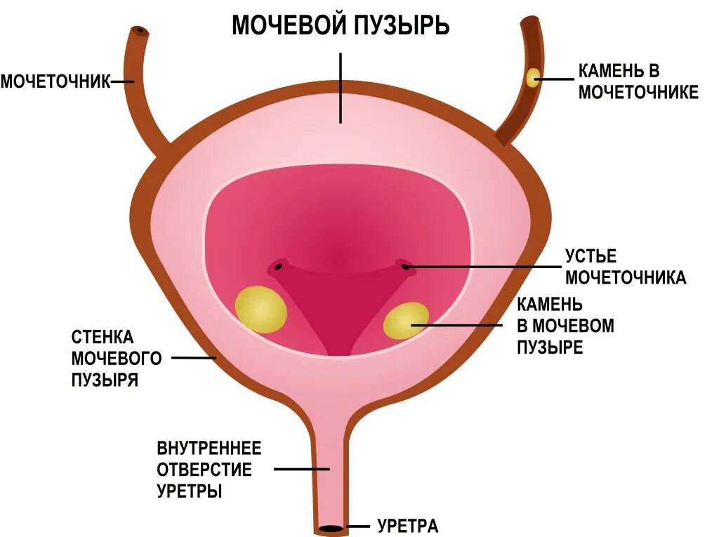 Мочевой рецидив. Конкремент устья мочевого пузыря. Мочевой пузырь схема. Анатомия матка и мочевой пузырь.