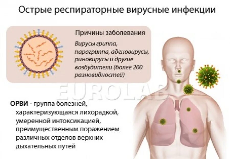 Появление гриппа. Острые респираторные вирусные инфекции симптомы. Патогенез острых респираторных заболеваний. Острые респираторные заболевания (ОРЗ). Причины острых респираторных заболеваний.