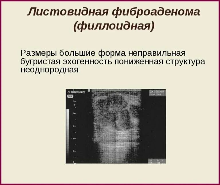 Фиброаденомы форум отзывы. Листовидная форма новообразования молочной железы. Структура фиброаденомы молочной железы. Филлоидная опухоль молочной железы УЗИ. Фиброаденома неоднородной структуры.