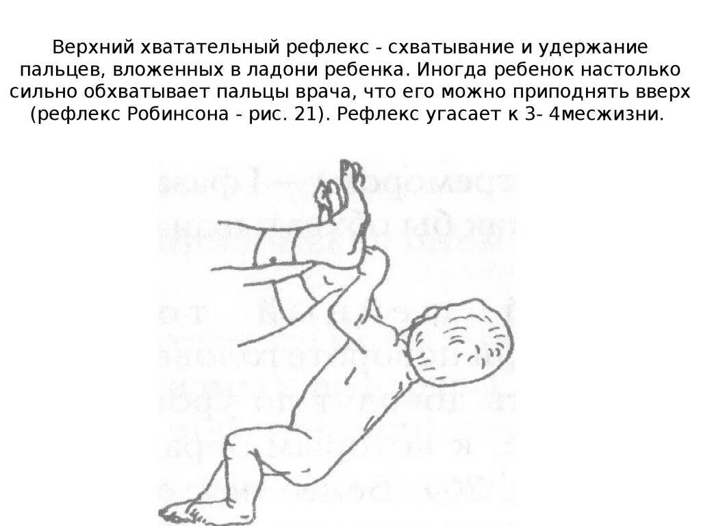 Рефлекс упражнение. Хватательный рефлекс у новорожденных. Рефлекс Робинсона у новорожденного. Ладонный хватательный рефлекс Робинсона. Шейно-тонический рефлекс новорожденного.