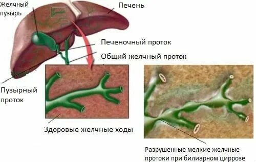 Симптомы забитых желчных протоков. Пузырный проток печени. Пузырный проток желчного пузыря. Утолщение протоков желчного пузыря. Внутрипеченочные желчевыводящие протоки.