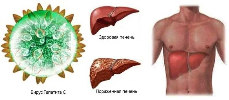 Эпидемический гепатит Боткина. Вирусный гепатит б.