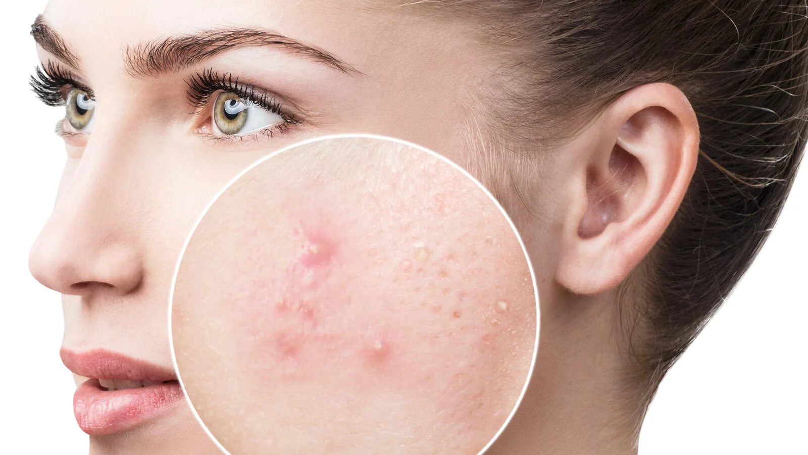 Acne pimple. Acne pimple