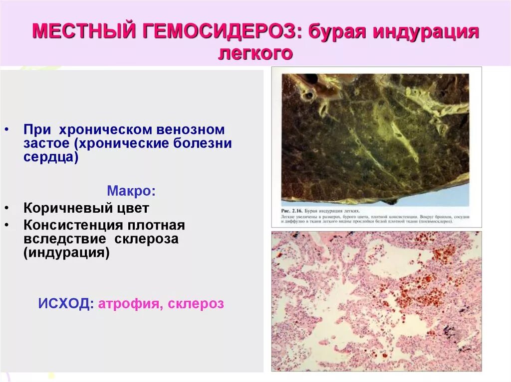 Печень при хроническом венозном застое. Гемосидероз селезенки препарат. Гемосидероз и гемохроматоз. Гемосидероз печени этиология. Бурая индурация легких макропрепарат.