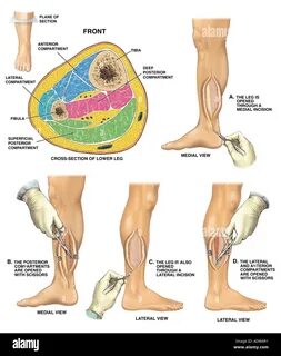 Leg syndrome