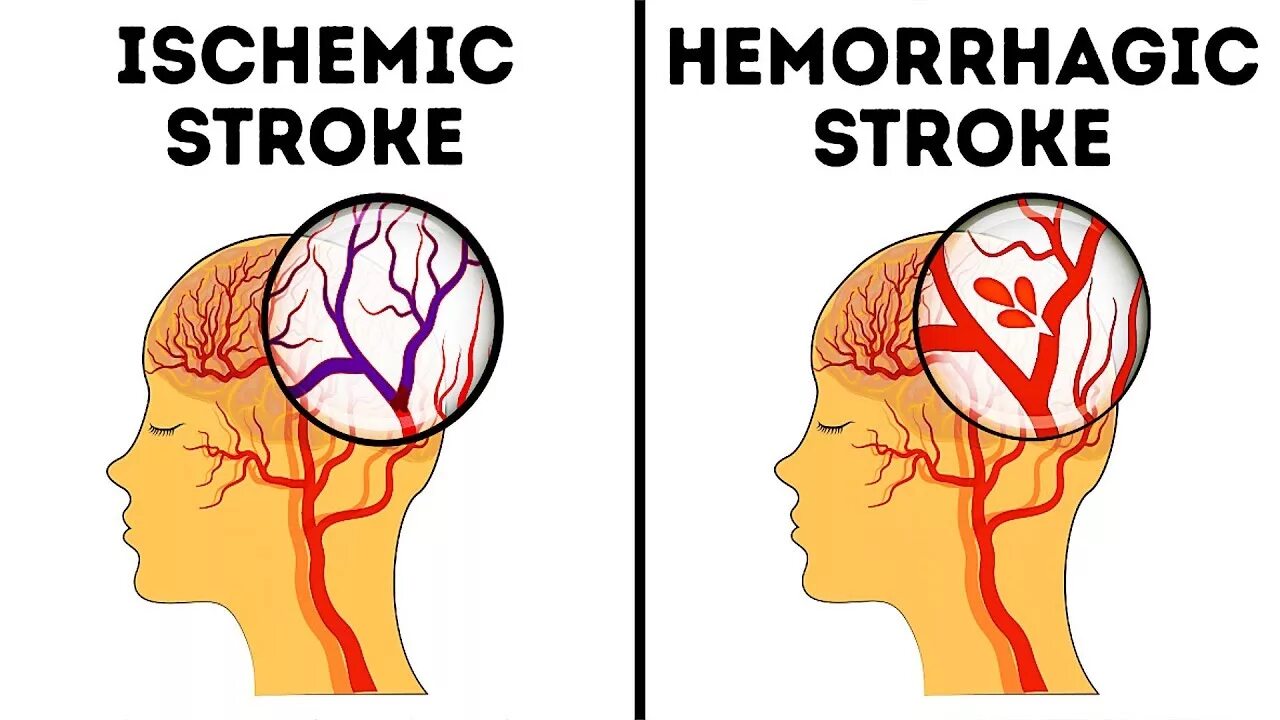 Чем отличается инфаркт от инсульта простыми. Инсульт. Геморрагический инсульт у пожилого. Инсульт картинки.