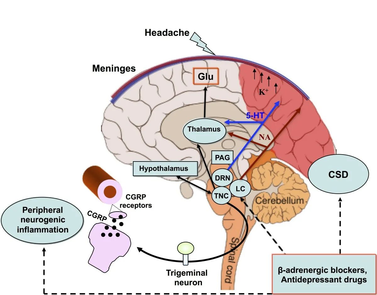 Патогенез мигрени схема. Мигрень механизм действия. Мигрень этиология. Теории возникновения мигрени. Лекарственно индуцированная головная боль