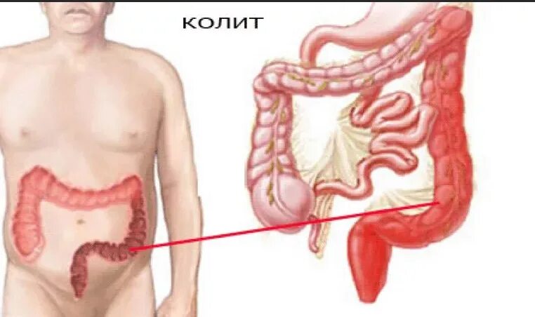 Болит кишечник симптомы. Синдром раздраженного кишечника толстой кишки симптомы. Болит слева кишечник причины. Болит внизу сбоку слева от живота. Вздутие и дискомфорт в кишечнике.