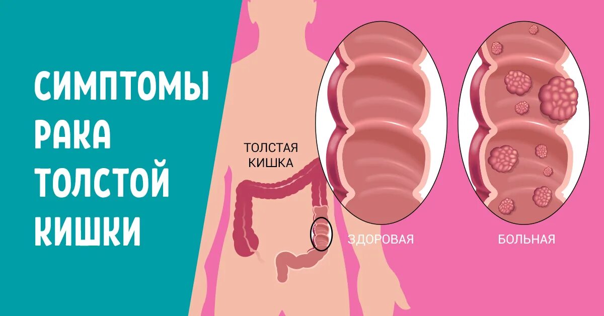 РПК кишечника симптому. Опухоль Толстого кишечника симптомы.