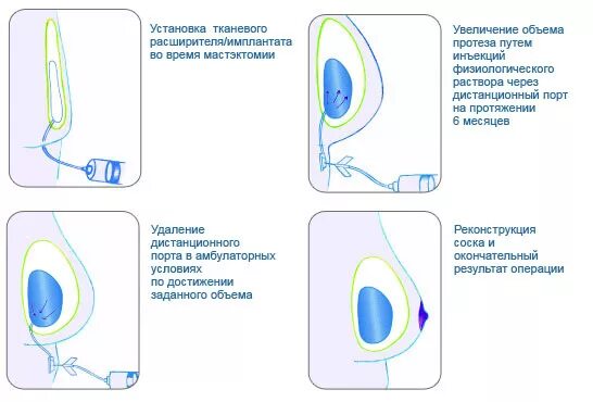 Через сколько можно есть после установки имплантов