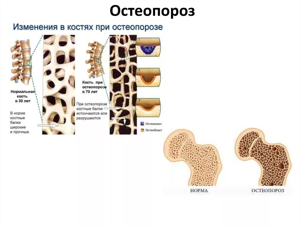 Остеопороз губчатого вещества. Нормальная кость и остеопороз. Остеопороз костей позвоночника. Заболевание костей остеопороз.
