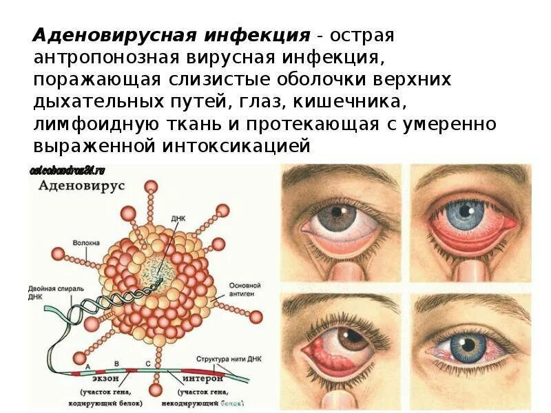 Аденовирусный конъюнктивит глаз. Аденовирусная инфекция конъюнктивит. Клинические проявления аденовируса. Конъюнктивит при аденовирусной инфекции. Аденовирусная инфекция симптомы у взрослых и лечение